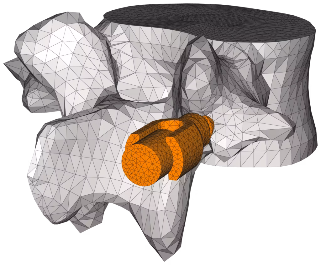 CM2 Intersect® T3 - Vertebra and implant - Merged meshes.