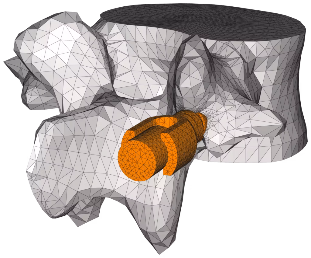 CM2 Intersect® T3 - Vertebra and implant - Merged meshes.
