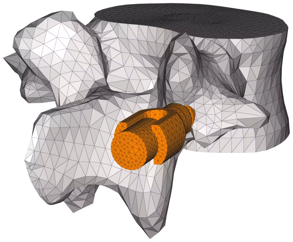 CM2 Intersect® T3 - Vertebra and implant. Initial meshes (view #2).