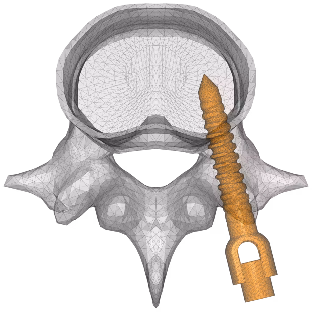 CM2 Intersect® T3 - Vertebra and implant. Initial meshes (view #1).